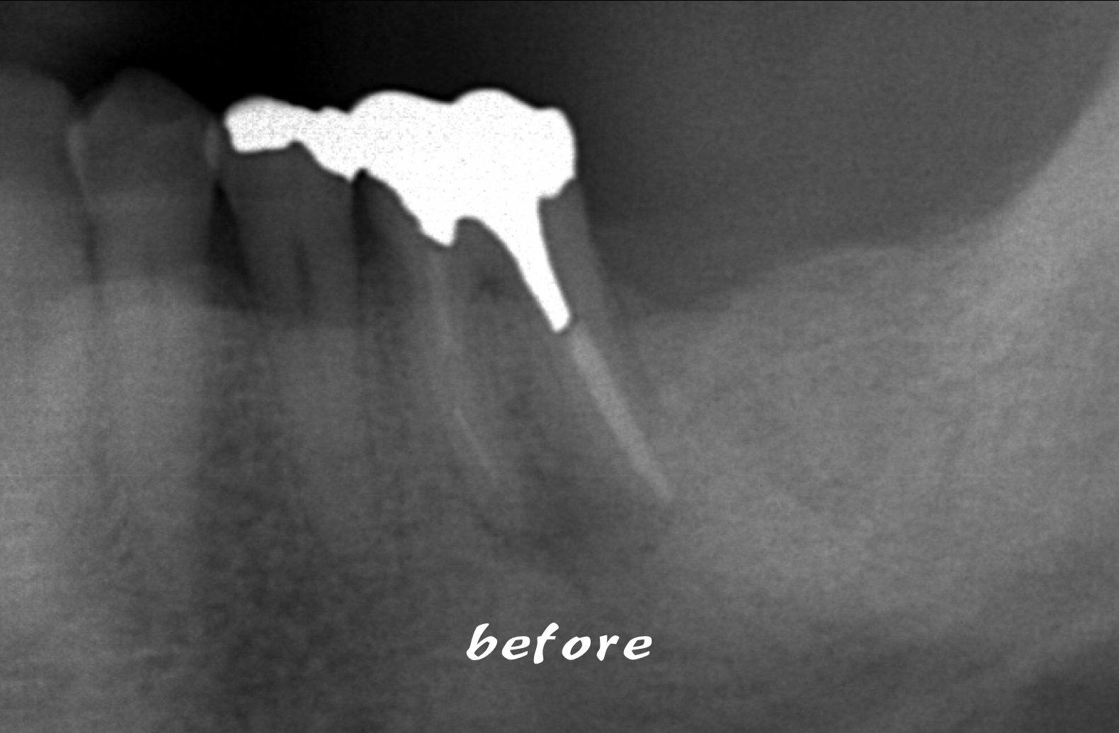 破折ファイルを除去して感染根管治療を行った症例