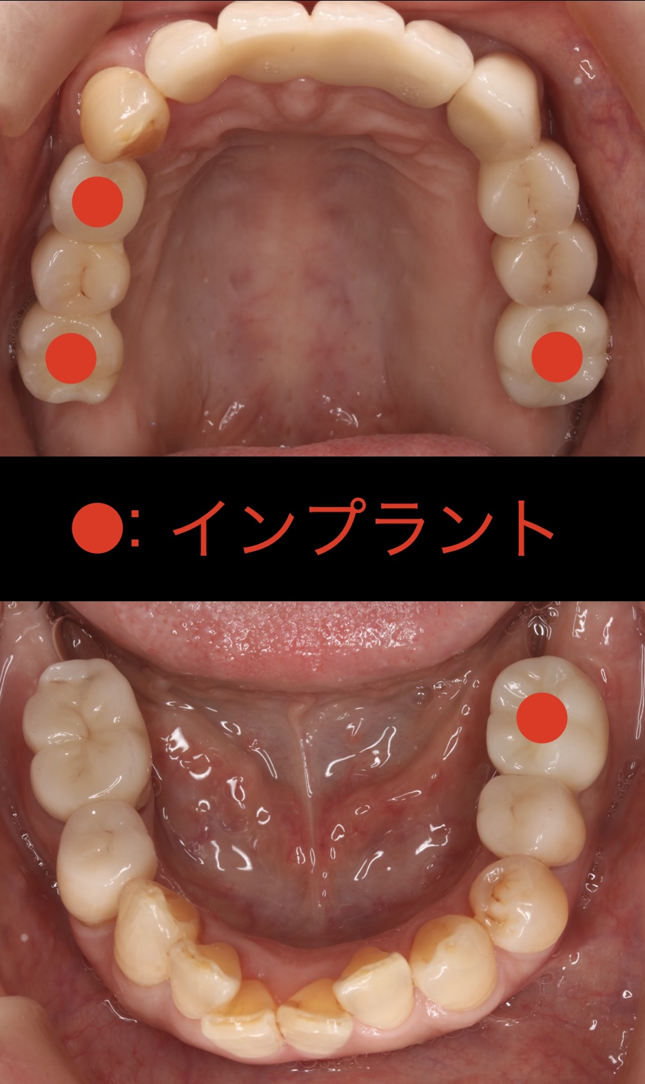 全顎的咬合再構成(フルマウスリコンストラクション)を行った症例