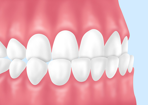 受け口（反対咬合・下顎前突）