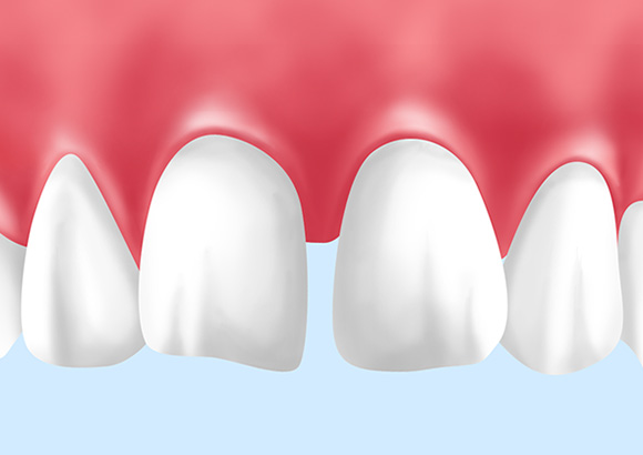 すきっ歯（空隙歯列）・正中離開