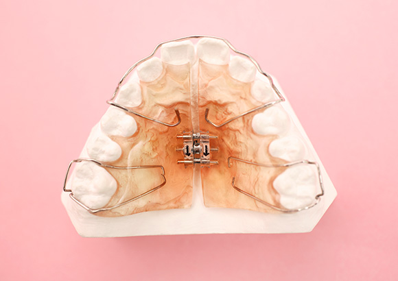 歯列矯正での第1期治療（床矯正）
