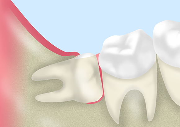 親知らずの抜歯