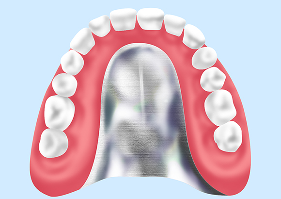 コバルトクロム床（金属床義歯）