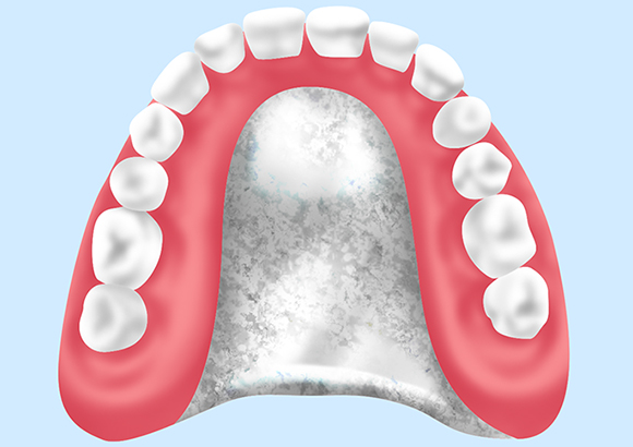 チタン床（金属床義歯）