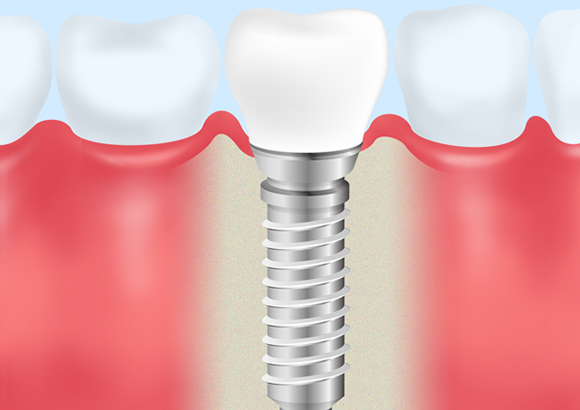 インプラント