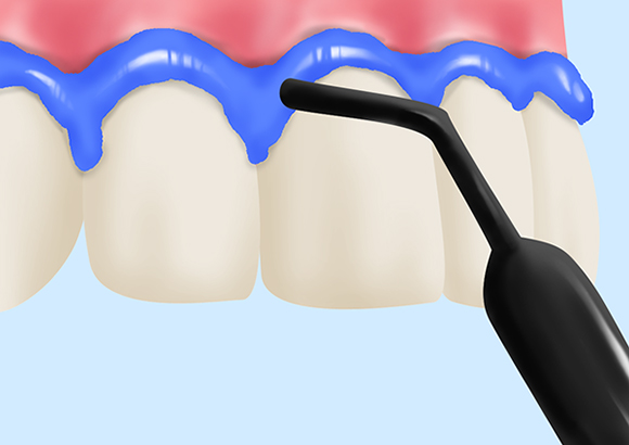 Step3歯ぐき保護、薬剤塗布