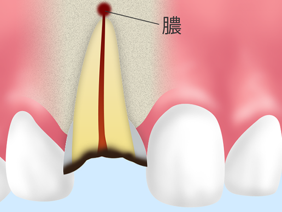 歯根端切除術