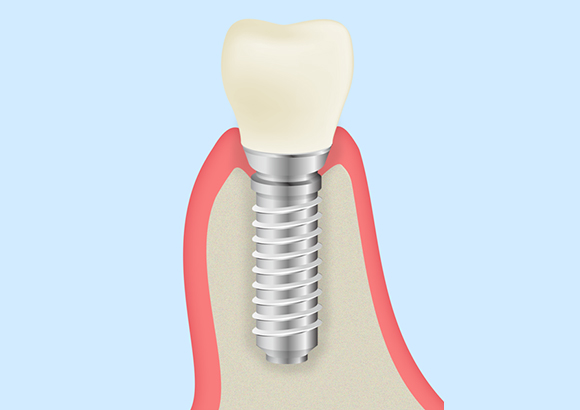 抜歯即時インプラント