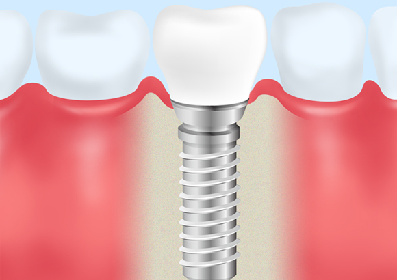 インプラント