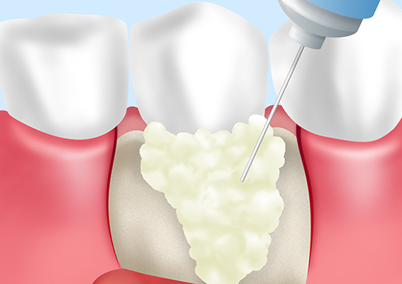 エムドゲイン（歯周組織再生療法）